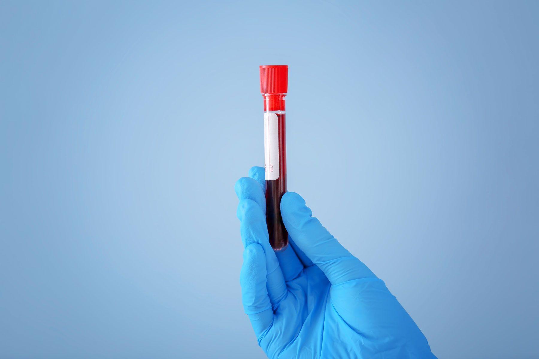 This blood test determines whether your body can use and store glucose normally, a key indicator of metabolic health or dysfunction. Here’s what you need to know and how one doctor uses the test in her practice.